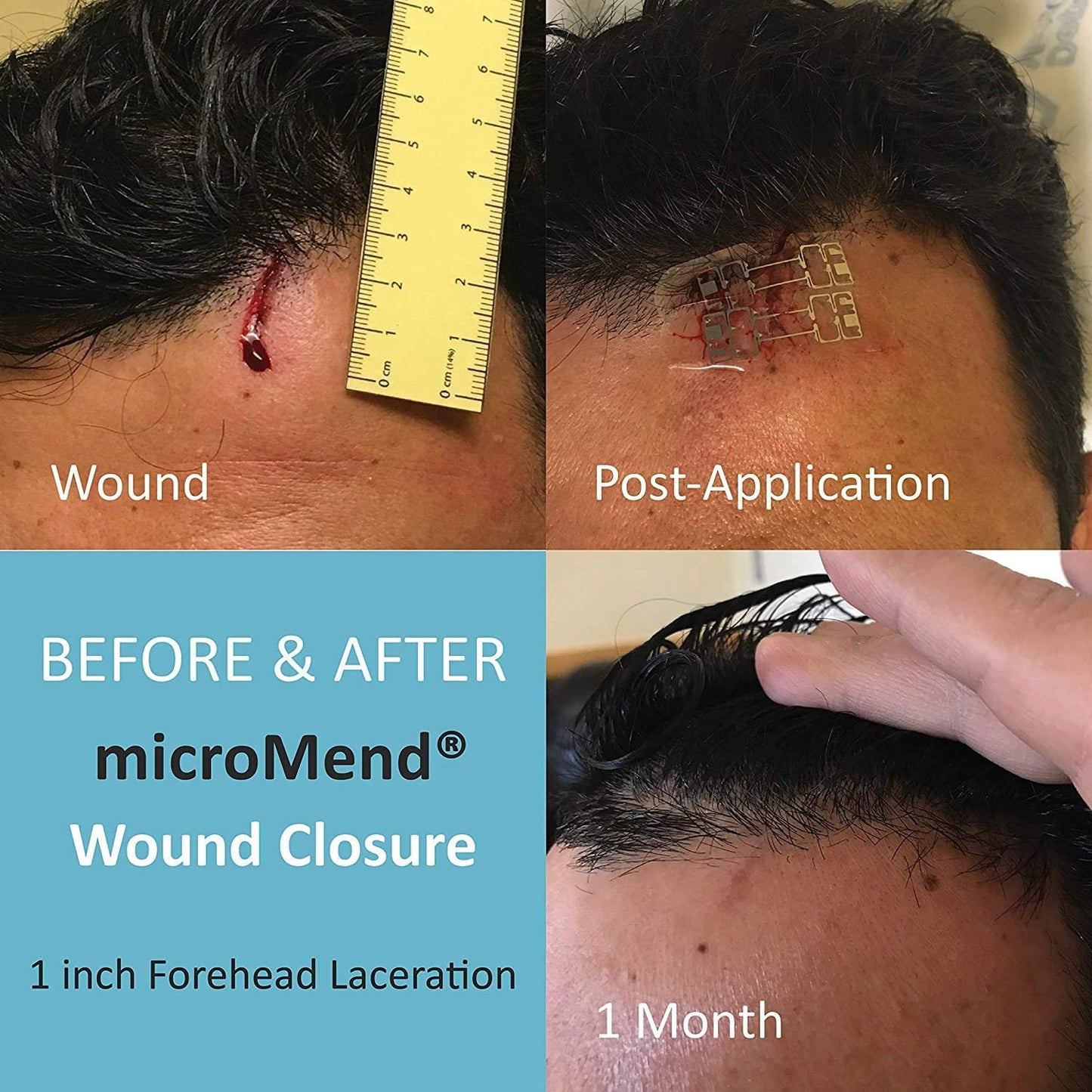 Emergency Wound Closures Surgical Quality Laceration Repair without Stitches - Think Ahead - Be Prepared - Add to Your Survival Kit, Camping Gear (Combo Pack - 2 Sizes: Small & Medium)